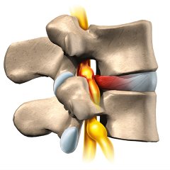 disc herniation